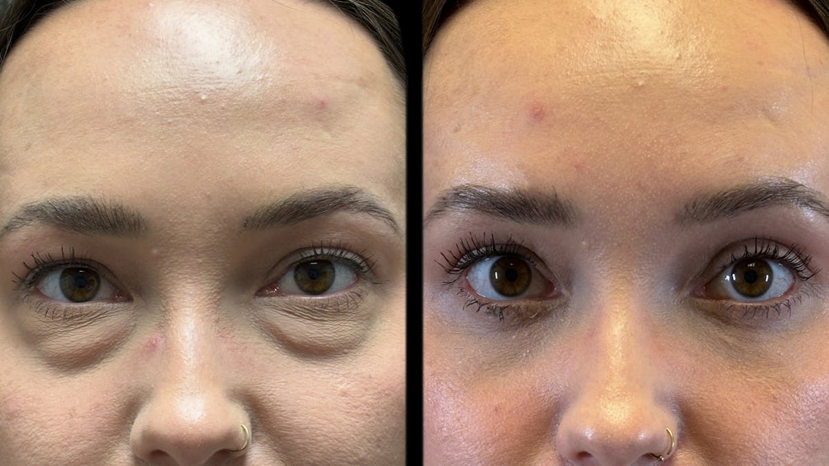 Lower Eyelid Surgery Before & After Gallery - Patient 226872 - Image 6