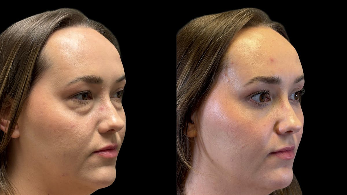 Lower Eyelid Surgery Before & After Gallery - Patient 226872 - Image 3