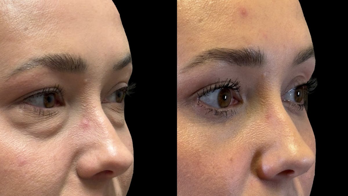 Lower Eyelid Surgery Before & After Gallery - Patient 226872 - Image 7