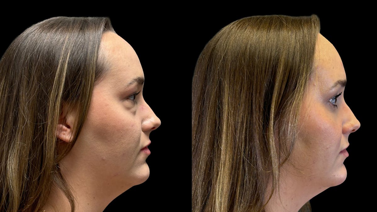 Lower Eyelid Surgery Before & After Gallery - Patient 226872 - Image 4