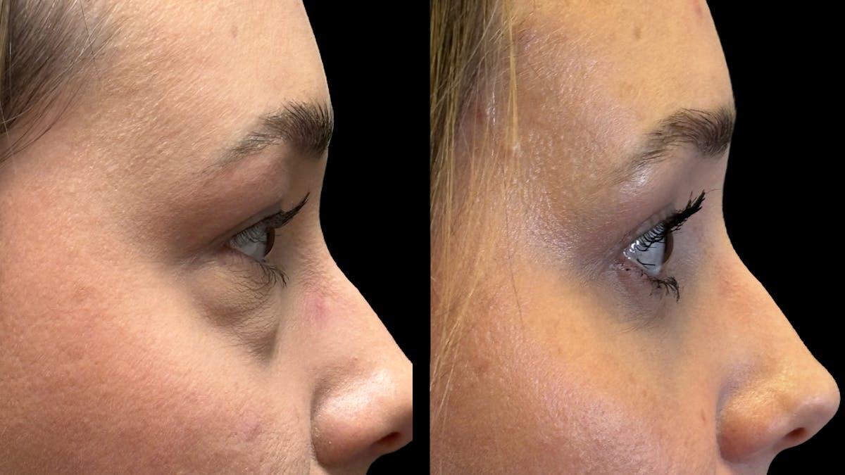 Lower Eyelid Surgery Before & After Gallery - Patient 226872 - Image 8