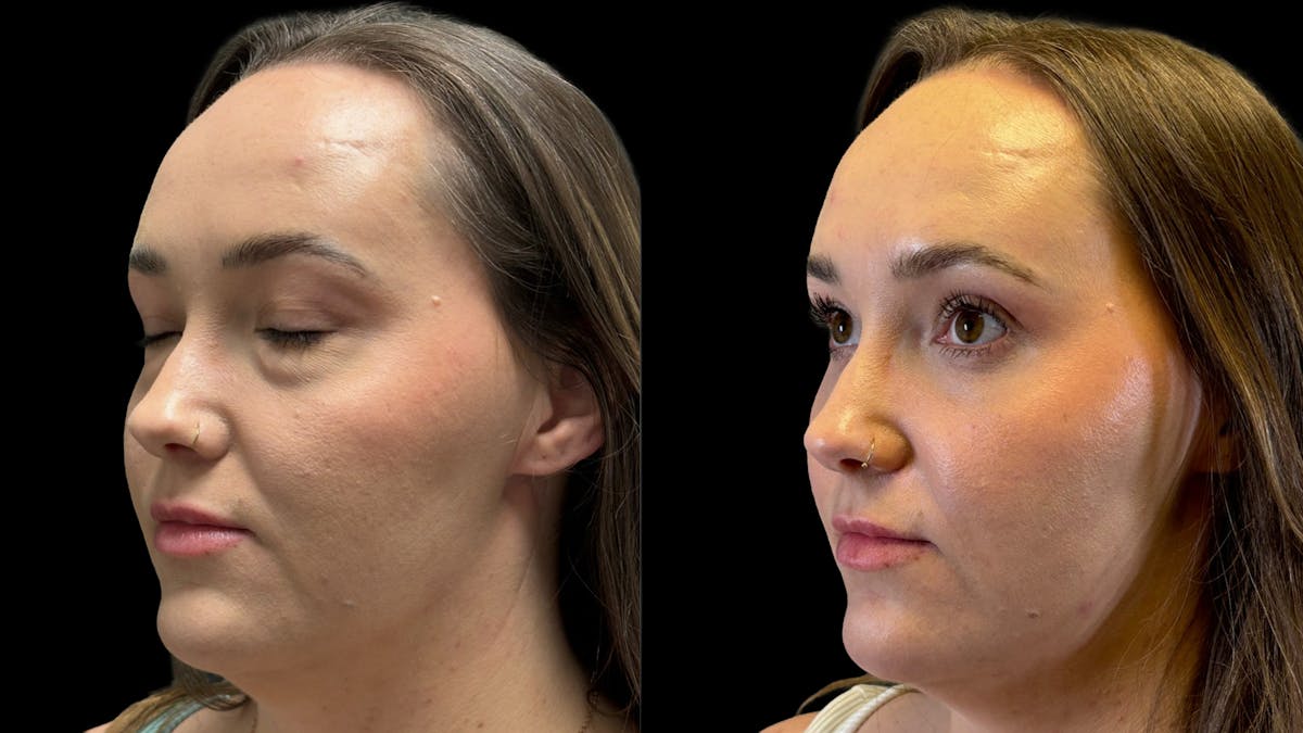 Lower Eyelid Surgery Before & After Gallery - Patient 226872 - Image 1