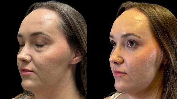 Lower Eyelid Surgery Before & After Gallery - Patient 226872 - Image 1