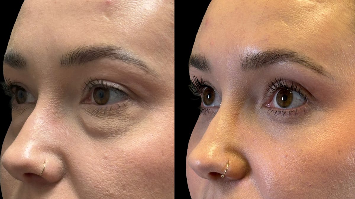 Lower Eyelid Surgery Before & After Gallery - Patient 226872 - Image 9