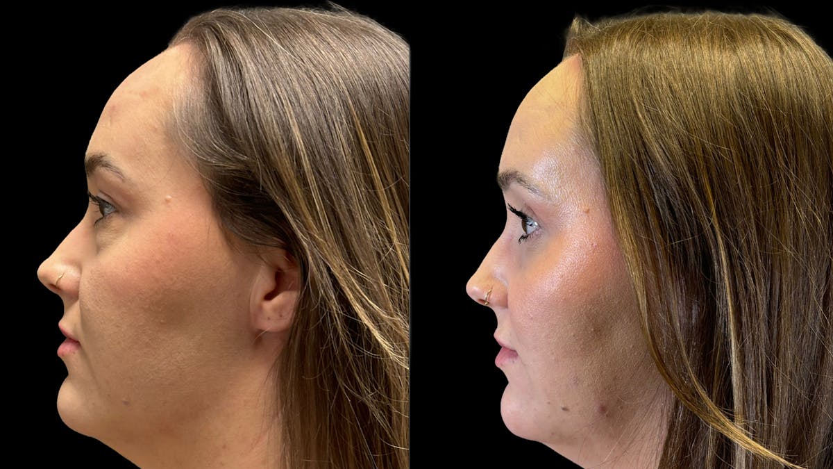 Lower Eyelid Surgery Before & After Gallery - Patient 226872 - Image 5