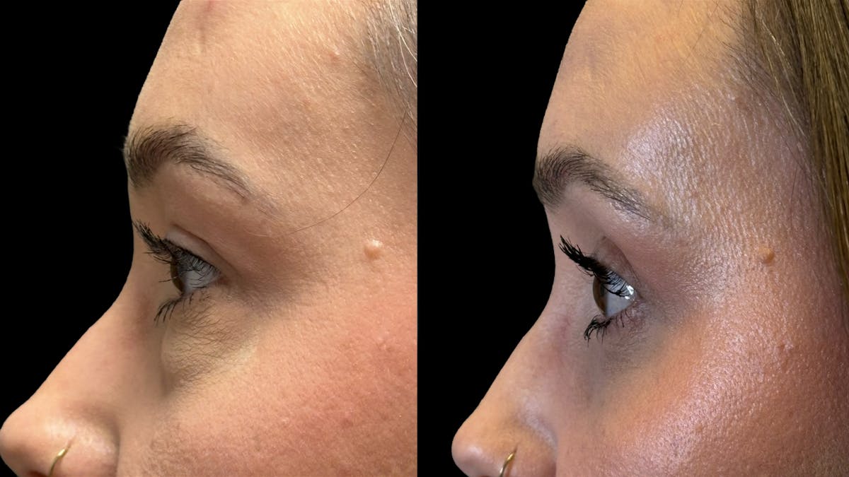 Lower Eyelid Surgery Before & After Gallery - Patient 226872 - Image 10
