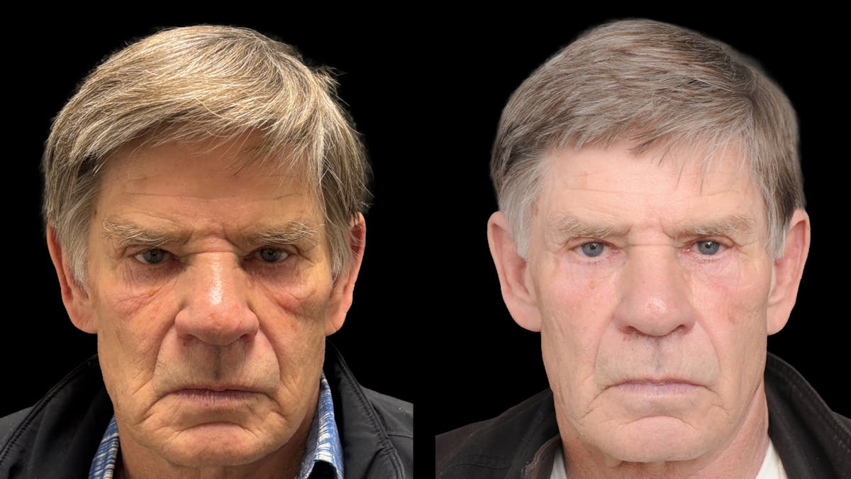 Lower Eyelid Surgery Before & After Gallery - Patient 351200 - Image 2