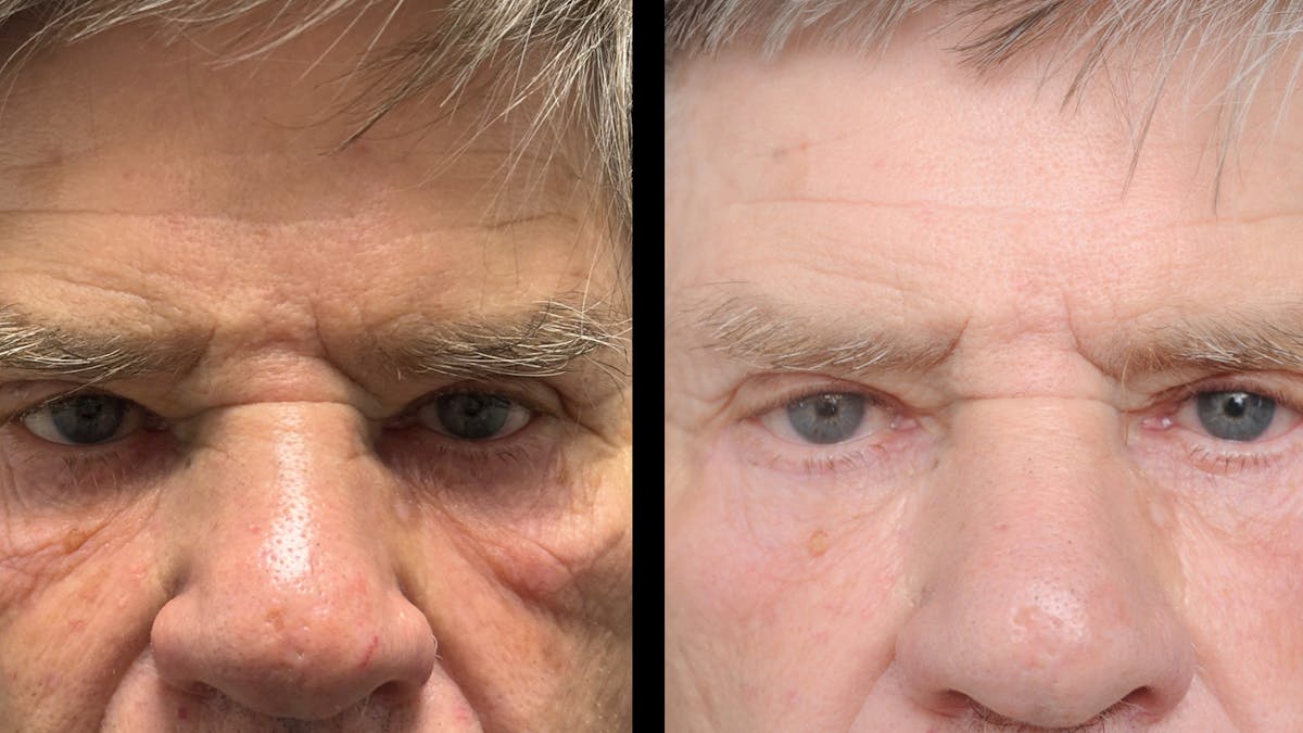Lower Eyelid Surgery Before & After Gallery - Patient 351200 - Image 6