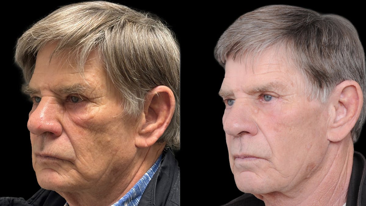 Lower Eyelid Surgery Before & After Gallery - Patient 351200 - Image 1