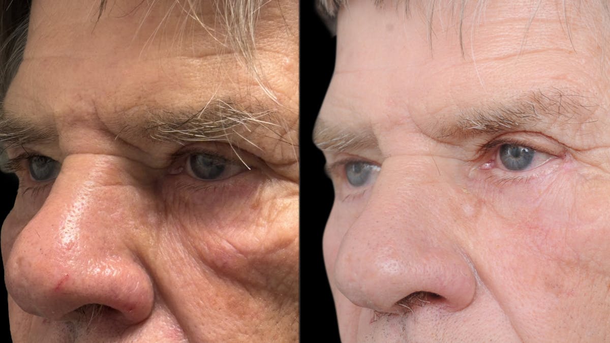 Lower Eyelid Surgery Before & After Gallery - Patient 351200 - Image 7
