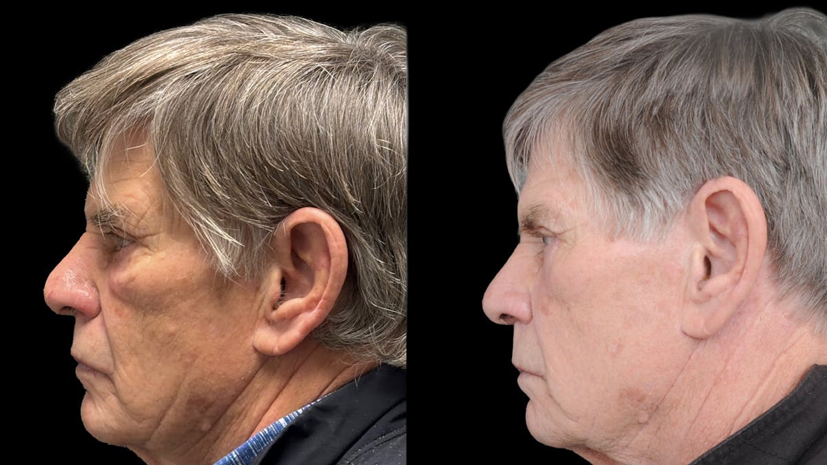 Lower Eyelid Surgery Before & After Gallery - Patient 351200 - Image 3