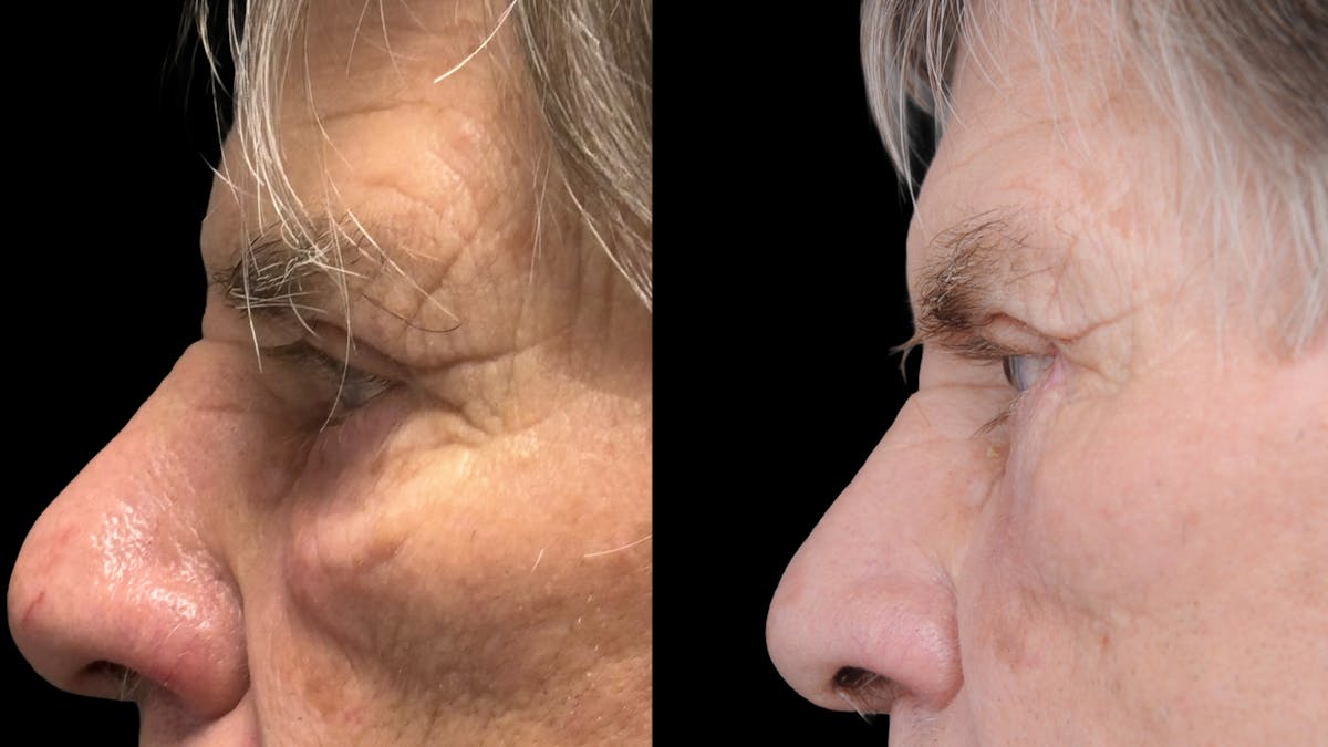 Lower Eyelid Surgery Before & After Gallery - Patient 351200 - Image 8