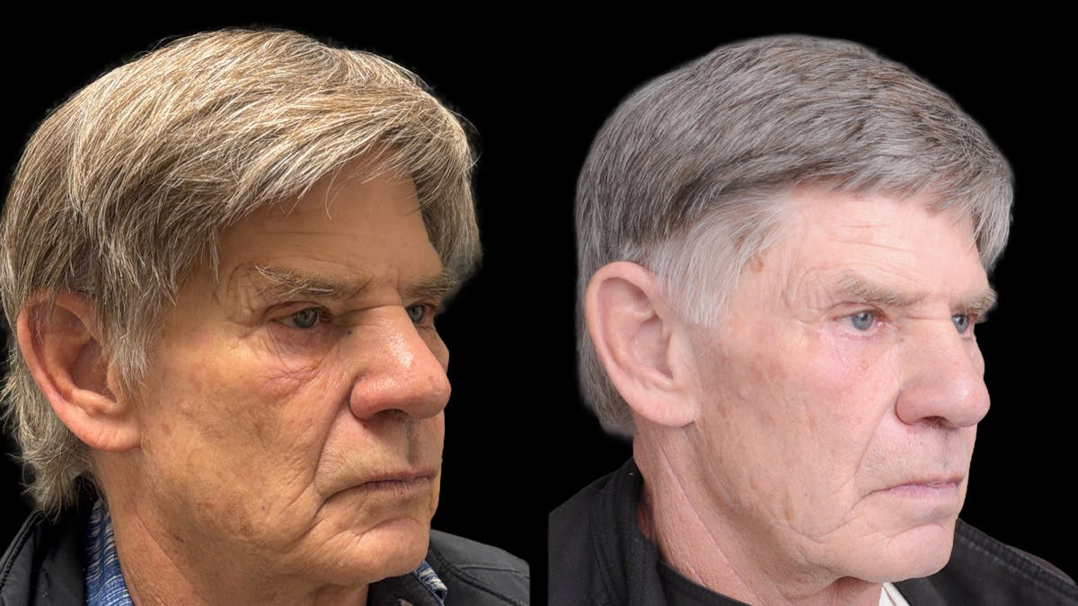 Lower Eyelid Surgery Before & After Gallery - Patient 351200 - Image 5