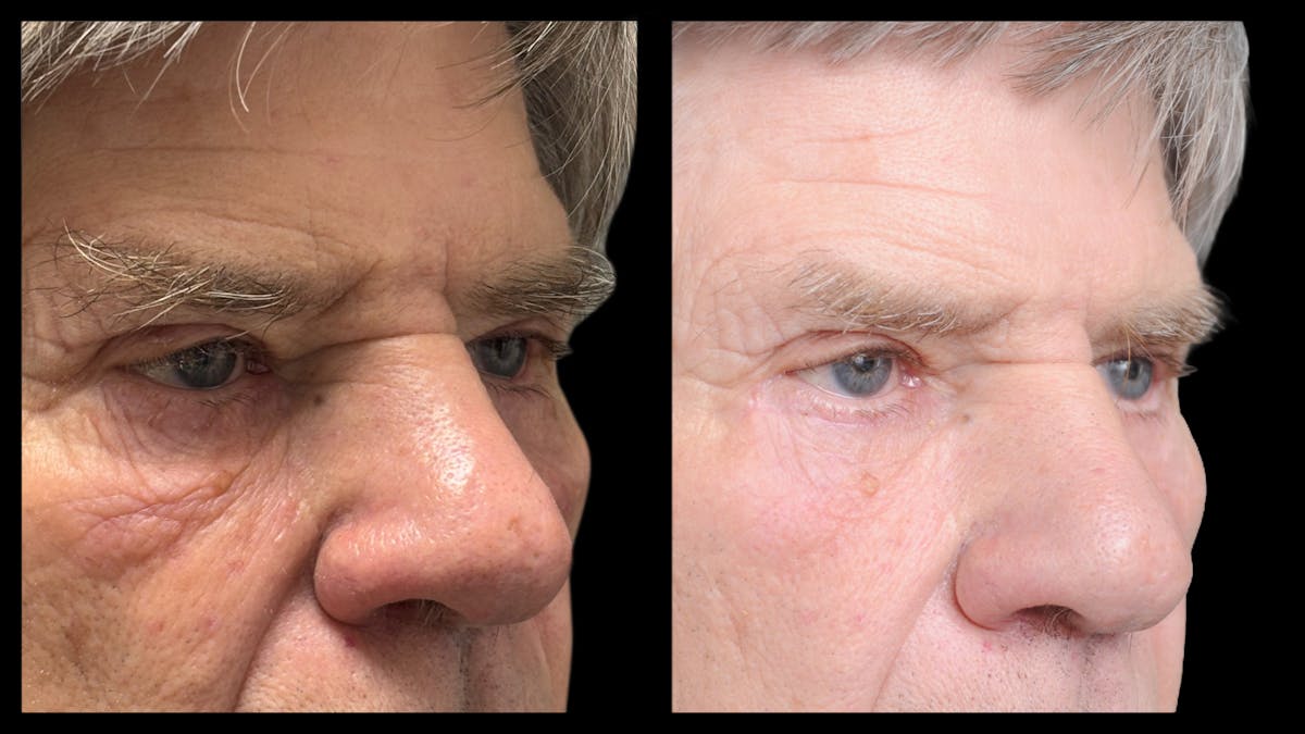 Lower Eyelid Surgery Before & After Gallery - Patient 351200 - Image 9