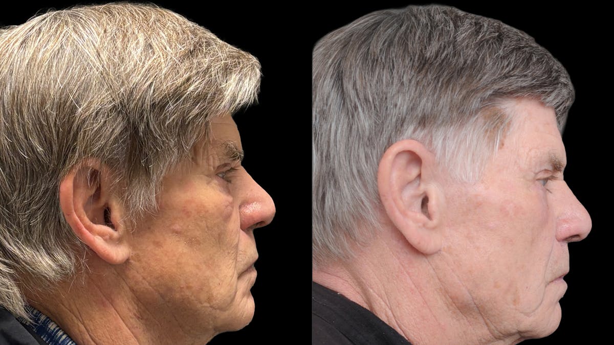 Lower Eyelid Surgery Before & After Gallery - Patient 351200 - Image 4