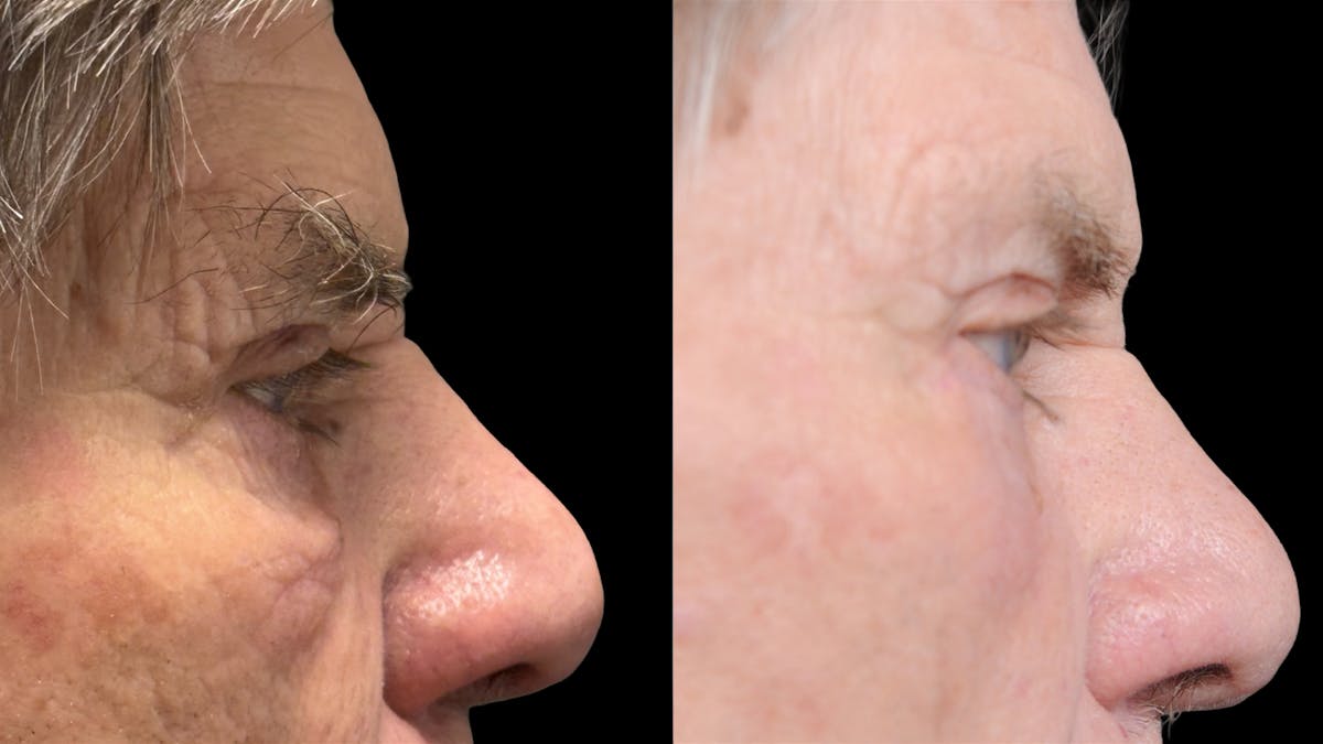 Lower Eyelid Surgery Before & After Gallery - Patient 351200 - Image 10