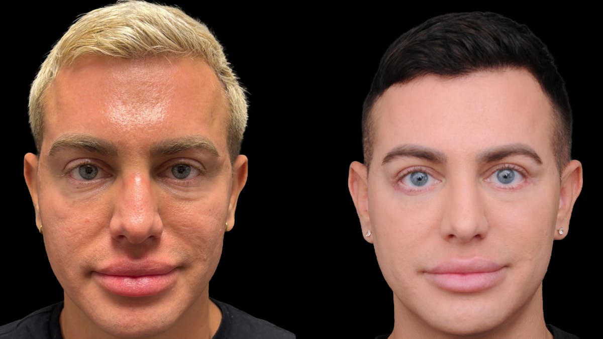 Lower Eyelid Surgery Before & After Gallery - Patient 256461 - Image 2