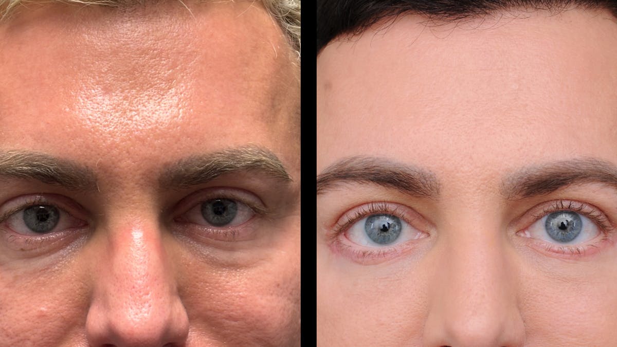 Lower Eyelid Surgery Before & After Gallery - Patient 256461 - Image 6