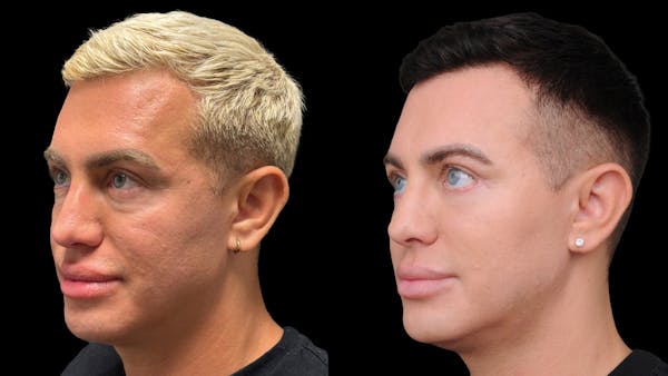 Lower Eyelid Surgery Before & After Gallery - Patient 256461 - Image 1