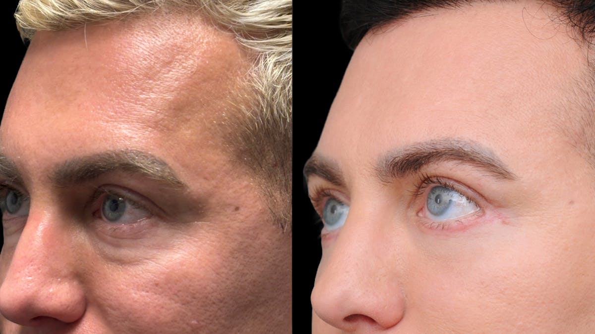 Lower Eyelid Surgery Before & After Gallery - Patient 256461 - Image 7