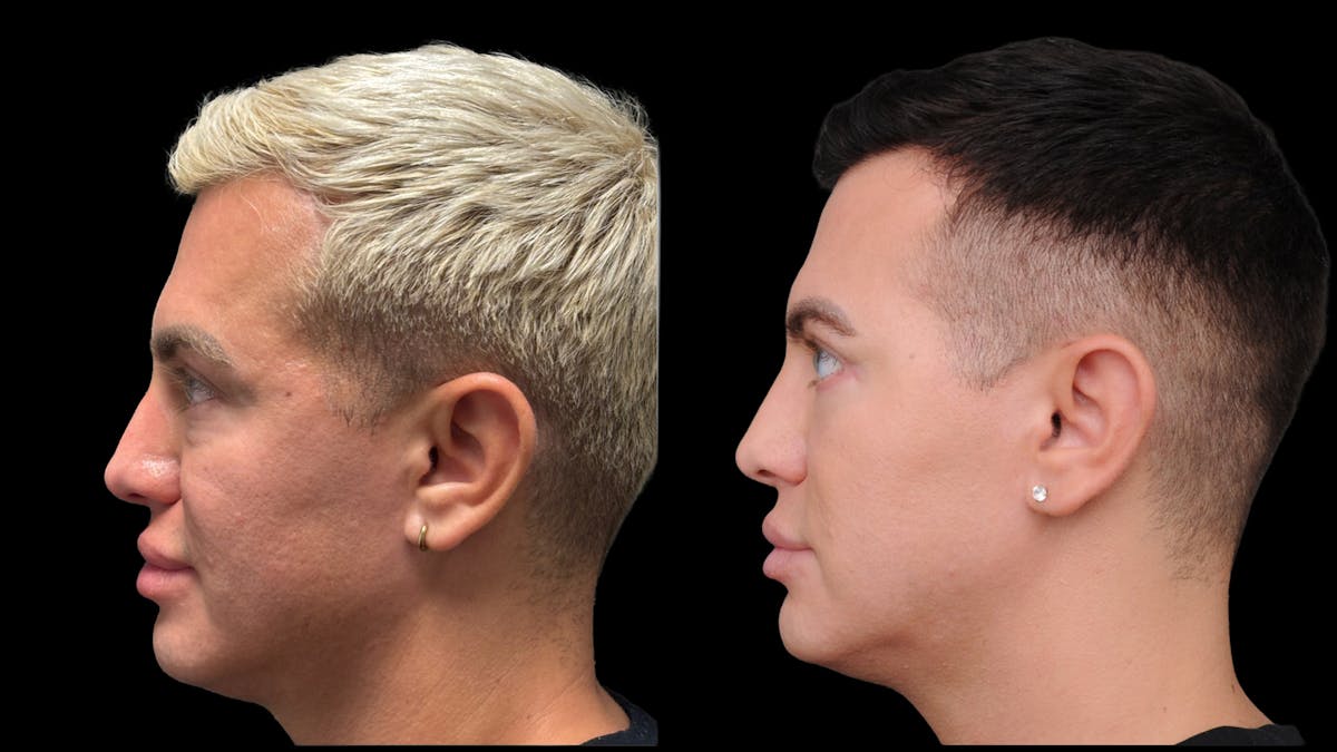 Lower Eyelid Surgery Before & After Gallery - Patient 256461 - Image 3