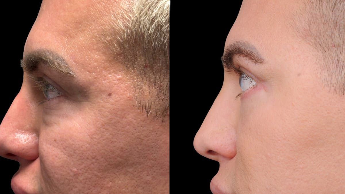 Lower Eyelid Surgery Before & After Gallery - Patient 256461 - Image 8