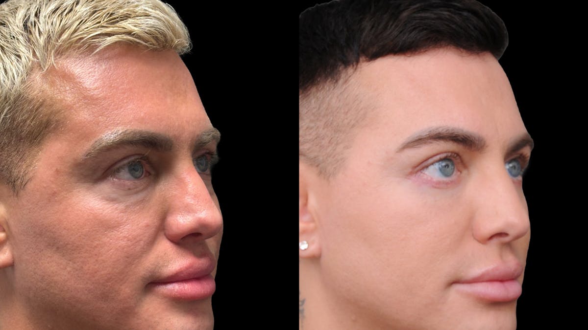 Lower Eyelid Surgery Before & After Gallery - Patient 256461 - Image 4