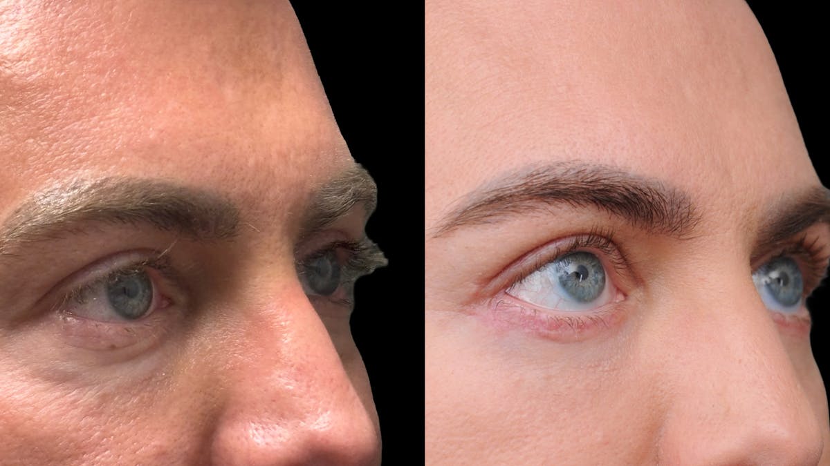 Lower Eyelid Surgery Before & After Gallery - Patient 256461 - Image 9