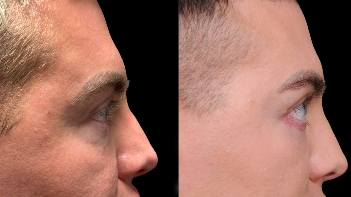 Lower Eyelid Surgery Before & After Gallery - Patient 256461 - Image 10