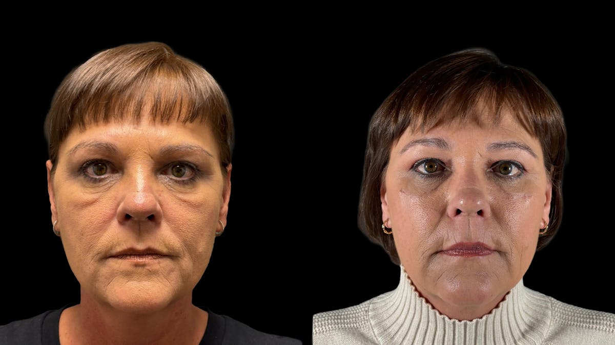 Lower Eyelid Surgery Before & After Gallery - Patient 112399 - Image 2