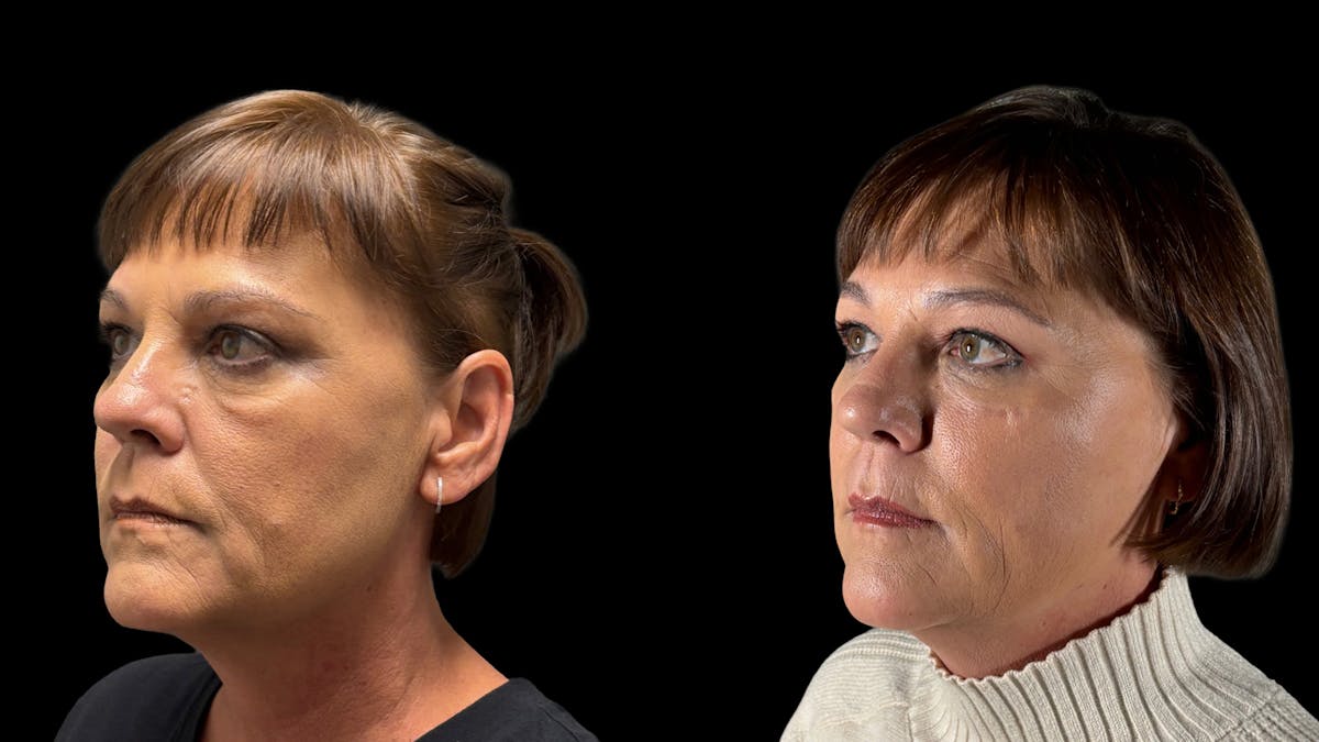 Lower Eyelid Surgery Before & After Gallery - Patient 112399 - Image 1