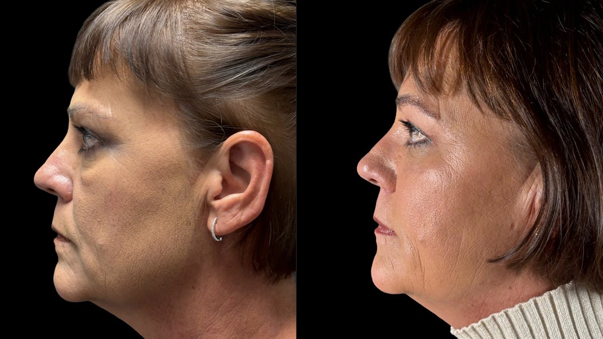 Lower Eyelid Surgery Before & After Gallery - Patient 112399 - Image 3