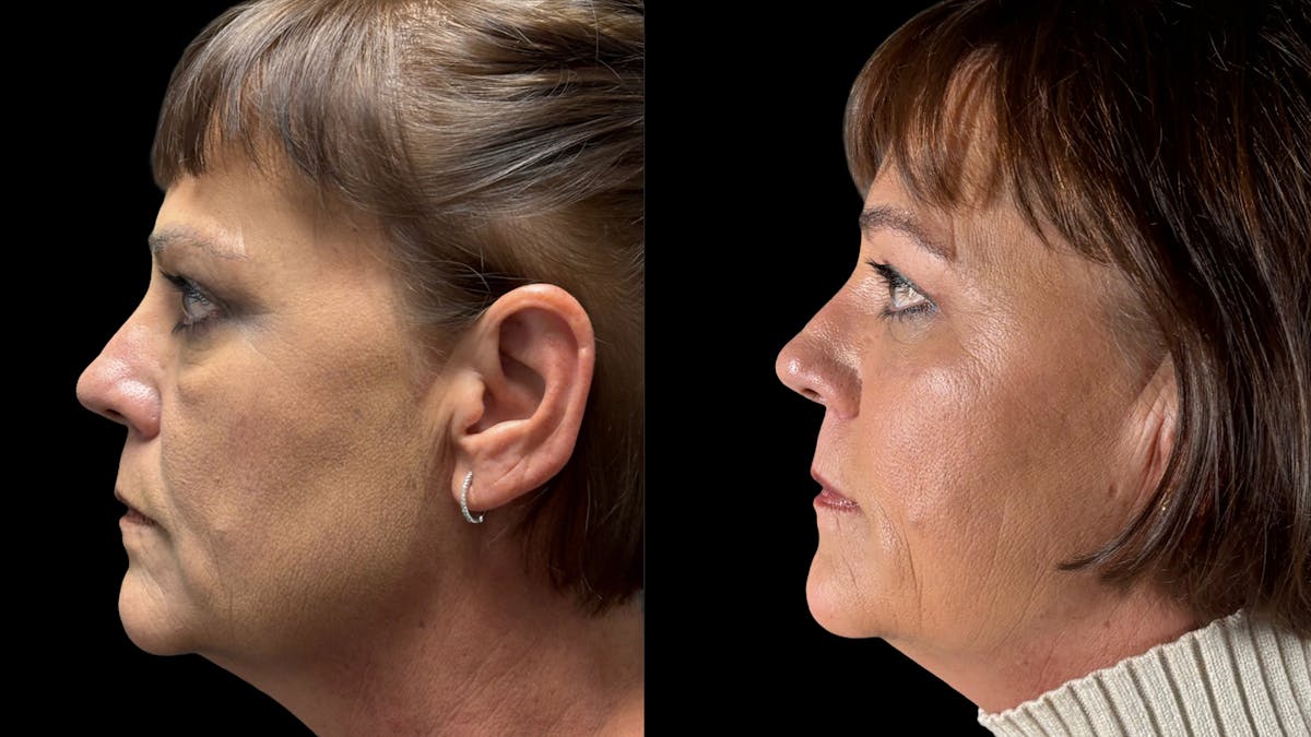 Lower Eyelid Surgery Before & After Gallery - Patient 112399 - Image 4