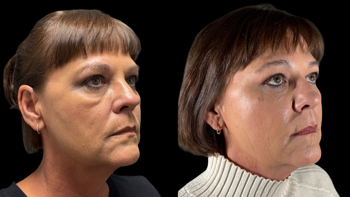 Lower Eyelid Surgery Before & After Gallery - Patient 112399 - Image 5