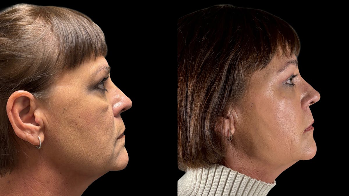 Lower Eyelid Surgery Before & After Gallery - Patient 112399 - Image 6