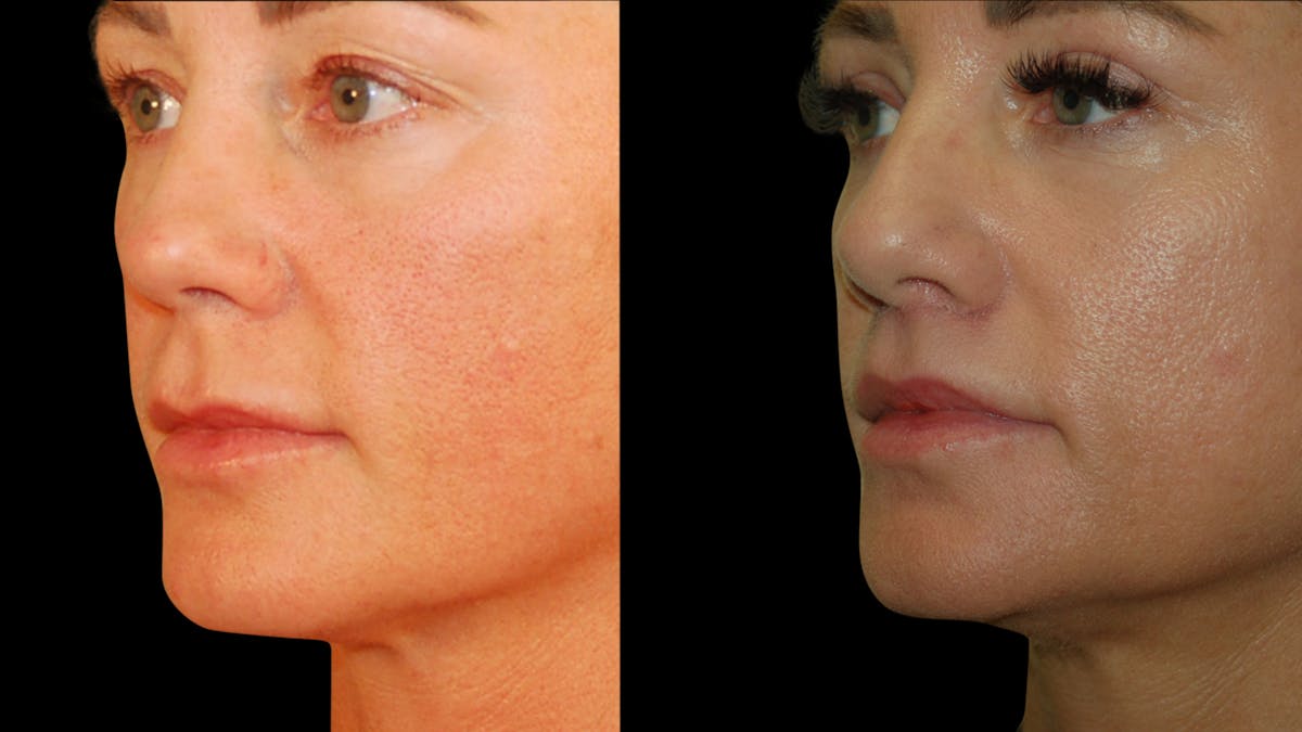 Lip Lift Before & After Gallery - Patient 801484 - Image 1
