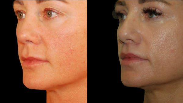 Lip Lift Before & After Gallery - Patient 801484 - Image 1