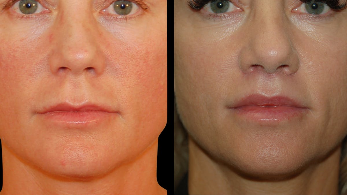 Lip Lift Before & After Gallery - Patient 801484 - Image 2
