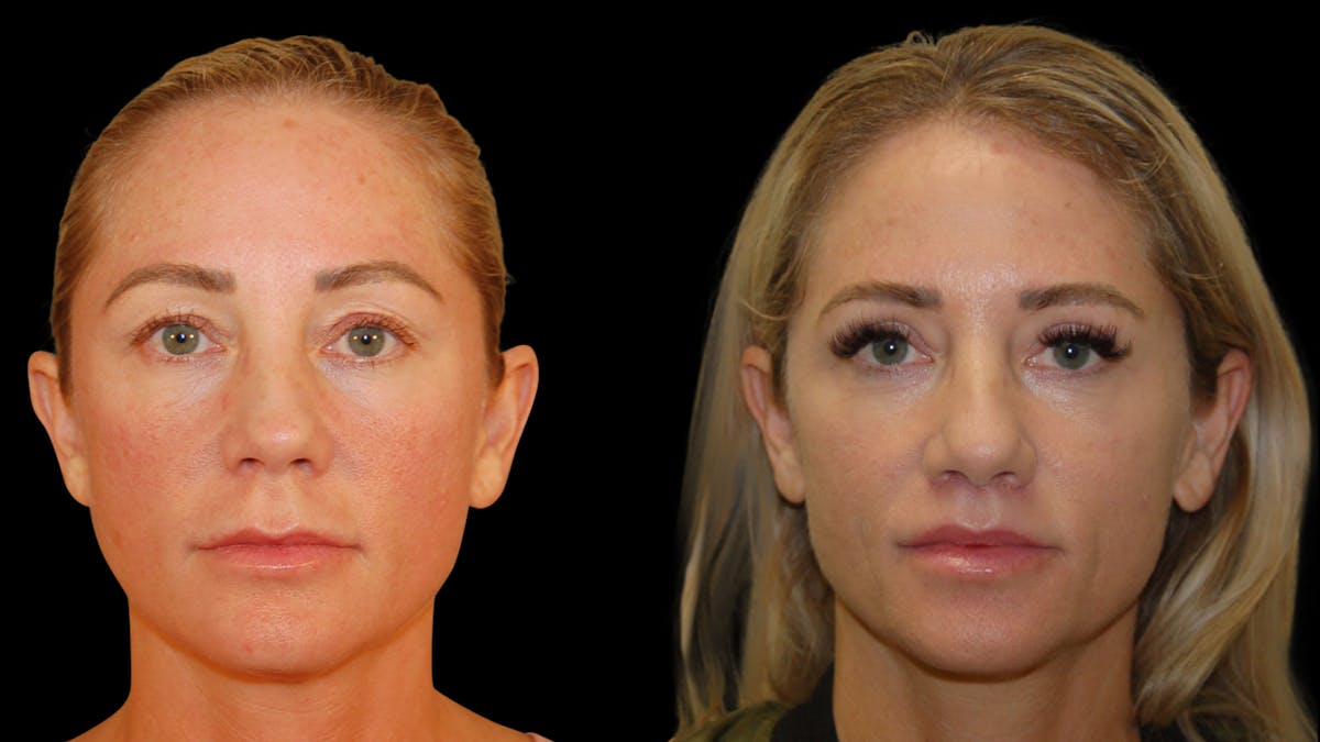 Lip Lift Before & After Gallery - Patient 801484 - Image 3