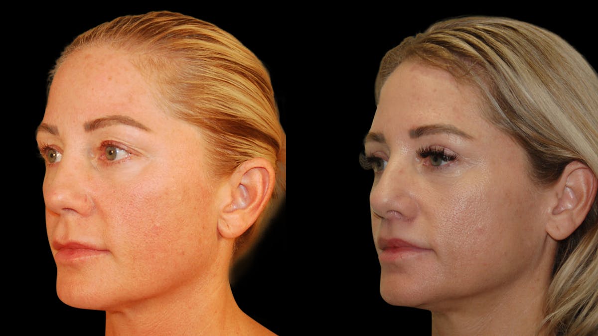 Lip Lift Before & After Gallery - Patient 801484 - Image 4