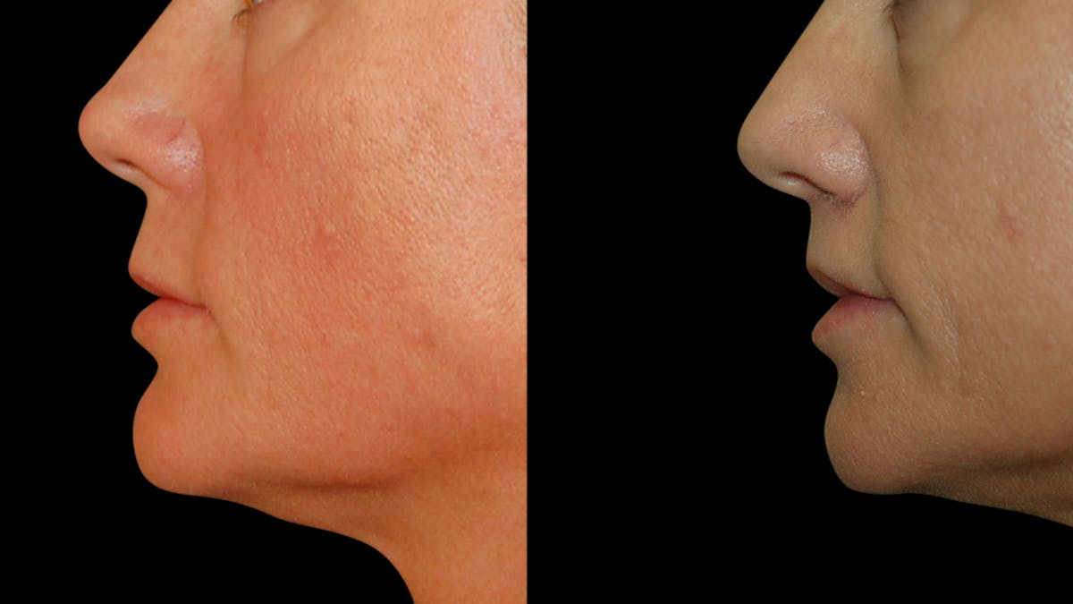 Lip Lift Before & After Gallery - Patient 801484 - Image 5