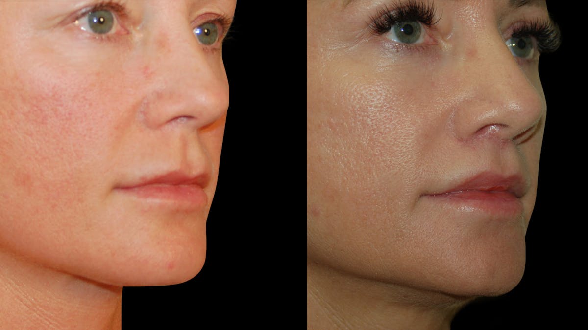 Lip Lift Before & After Gallery - Patient 801484 - Image 6