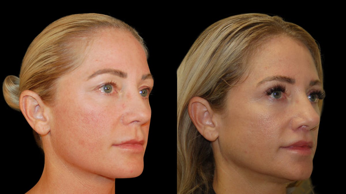 Lip Lift Before & After Gallery - Patient 801484 - Image 7