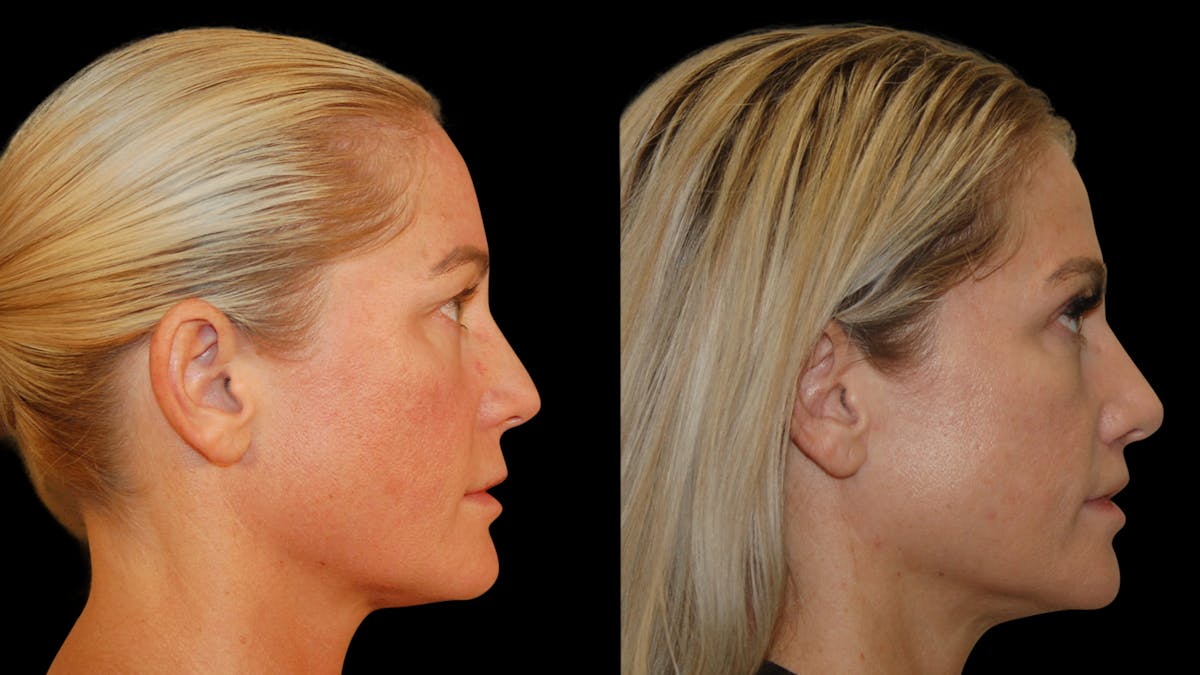 Lip Lift Before & After Gallery - Patient 801484 - Image 8