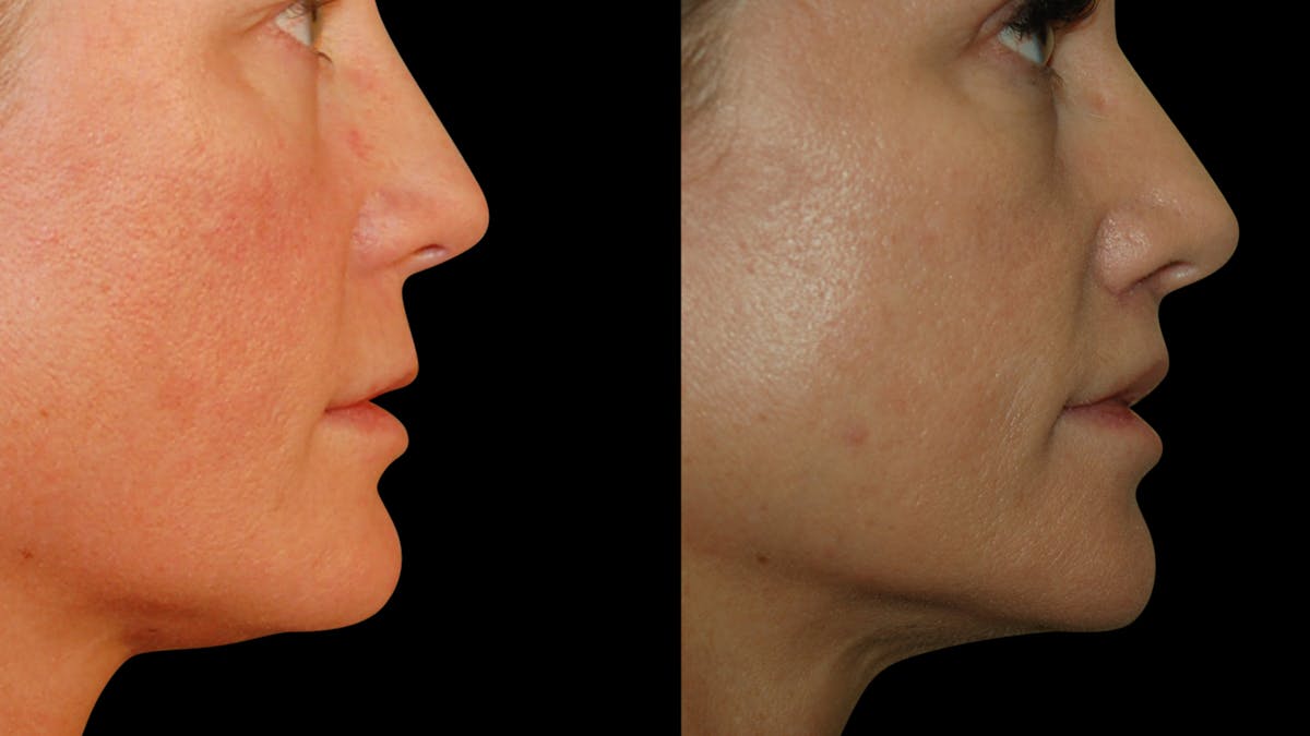 Lip Lift Before & After Gallery - Patient 801484 - Image 9