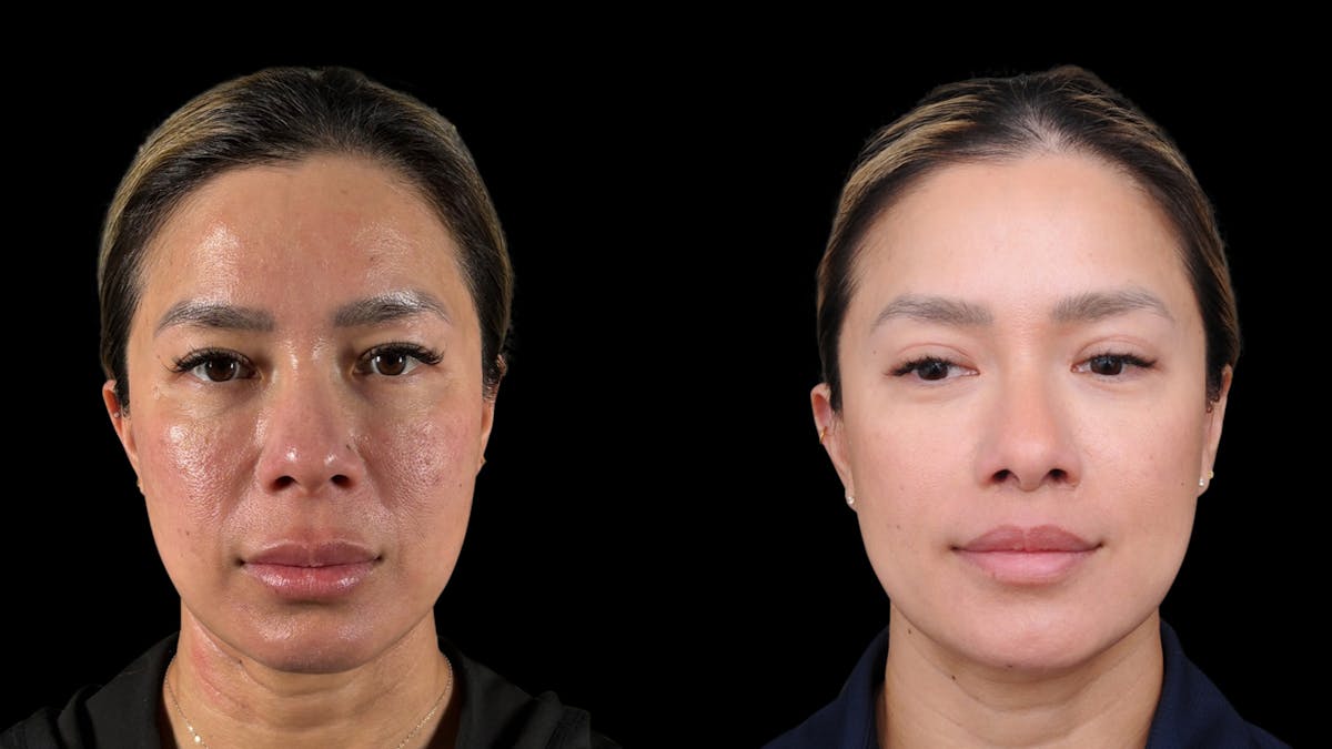 Lip Lift Before & After Gallery - Patient 301506 - Image 2