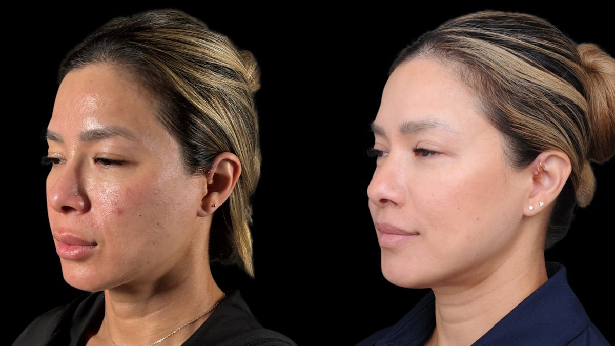 Lip Lift Before & After Gallery - Patient 301506 - Image 1