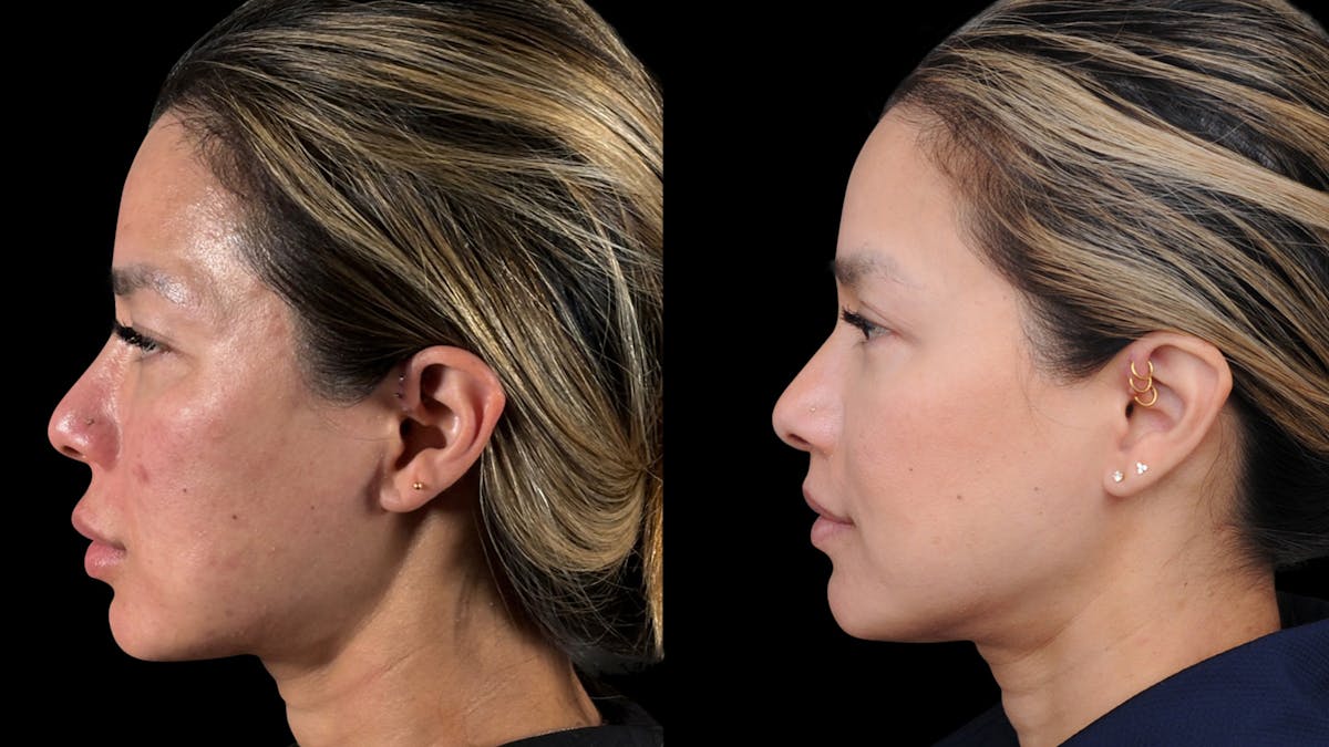 Lip Lift Before & After Gallery - Patient 301506 - Image 3