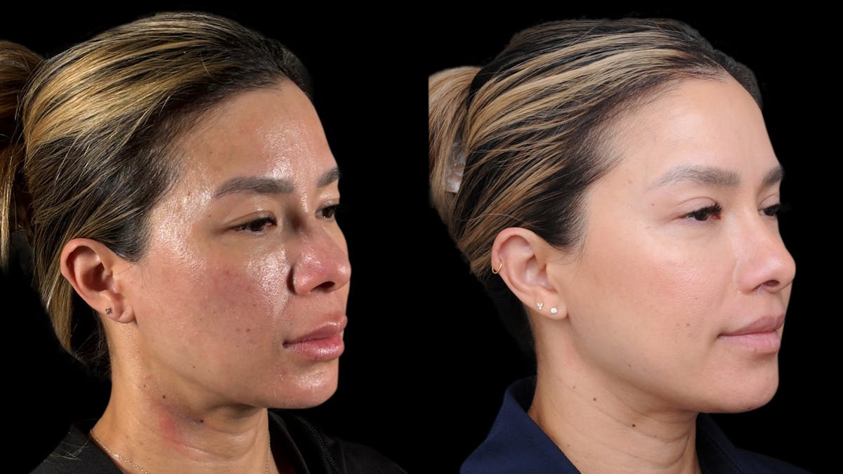 Lip Lift Before & After Gallery - Patient 301506 - Image 4
