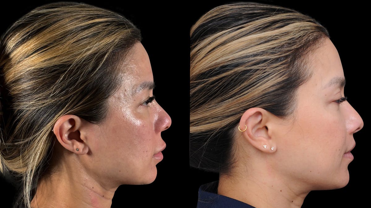 Lip Lift Before & After Gallery - Patient 301506 - Image 5